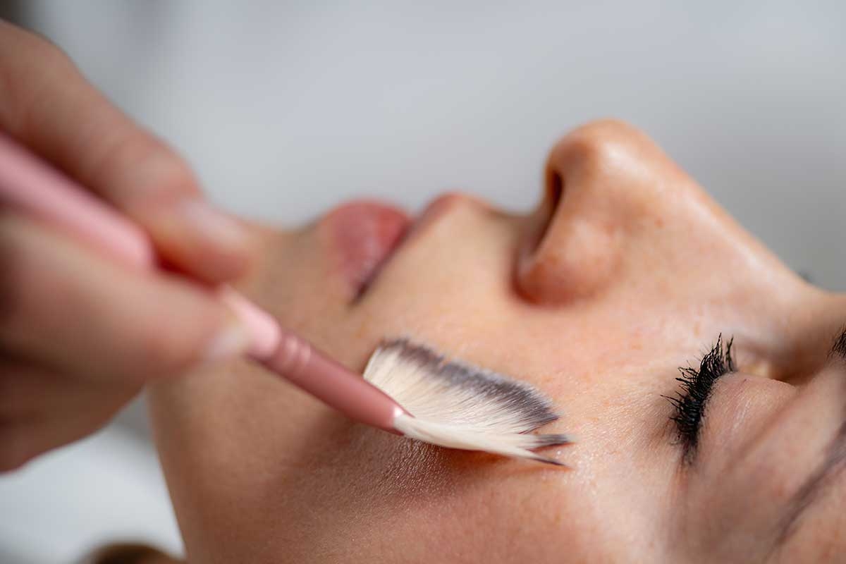 Chemical Peel in Nagapattinam