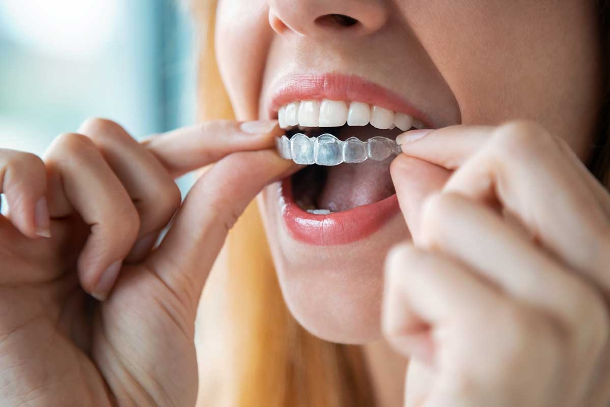 Invisalign Treatment in Malhargarh