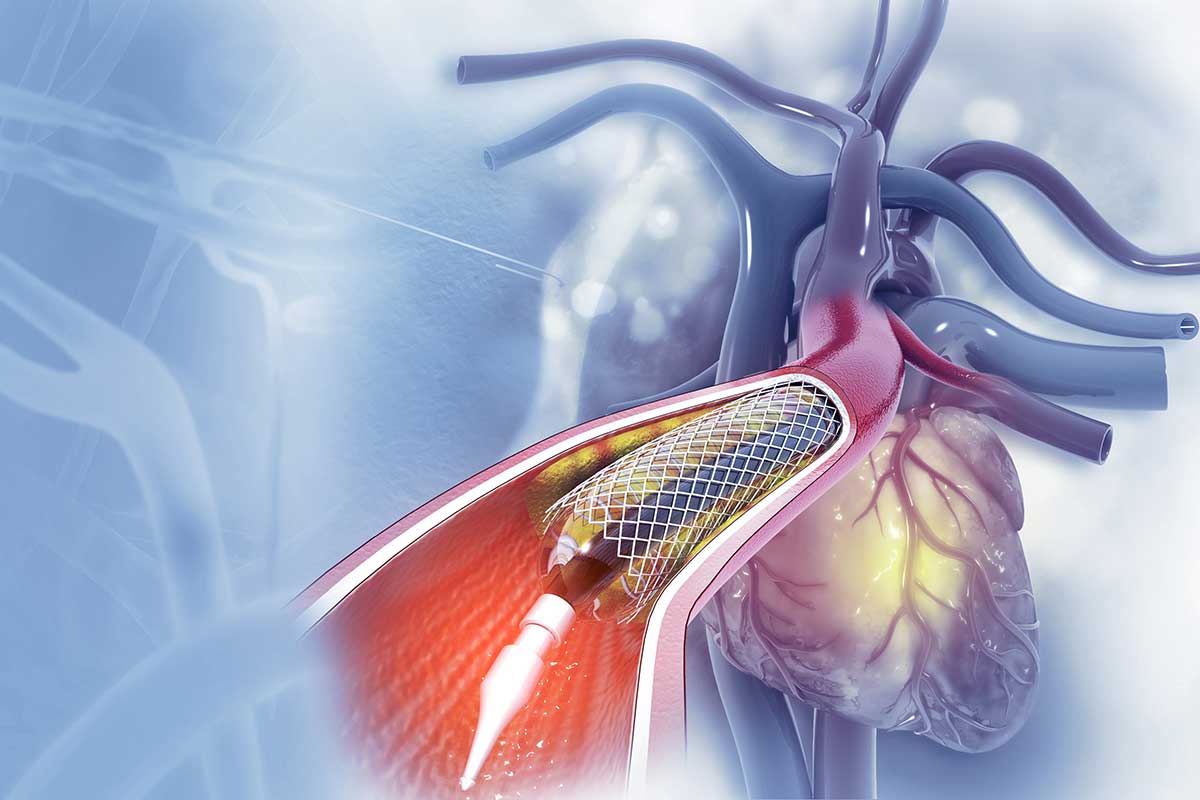 Angioplasty in Netaji Nagar